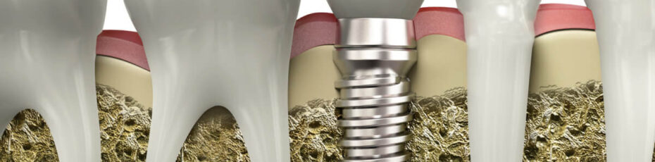 when to consider dental implants